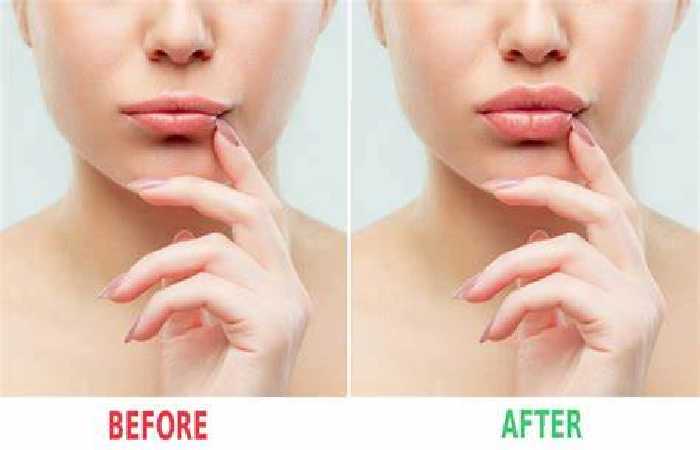 difference between a lip flip and a dermal filler